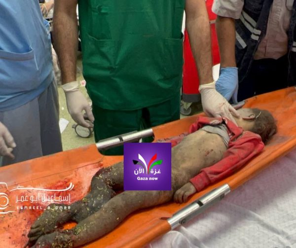 Hunger und Krankheiten als Waffe – Wie Israel das Gesundheitssystem in Gaza torpediert